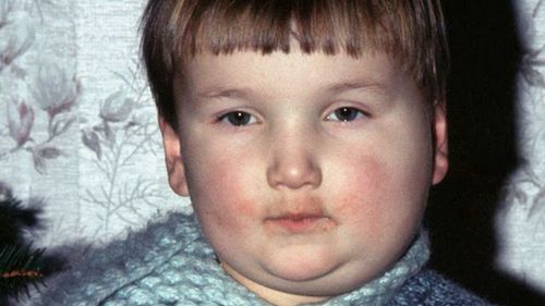 Chłopiec z obrzękiem ślinianek przyusznych podczas świnki