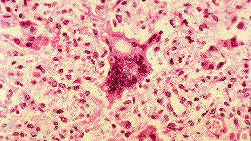 Histopatologiczny obraz odrowego zapalenia płuc