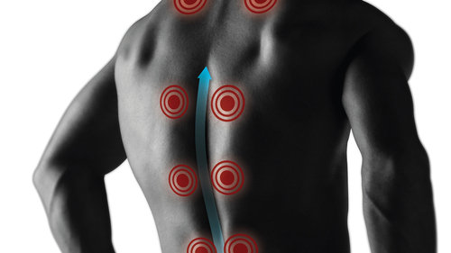 Zesztywniające zapalenie stawów kręgosłupa