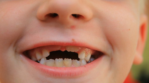 Utraty zębów mlecznych