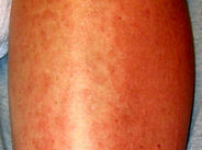 Pokrzywka alergiczna na nodze