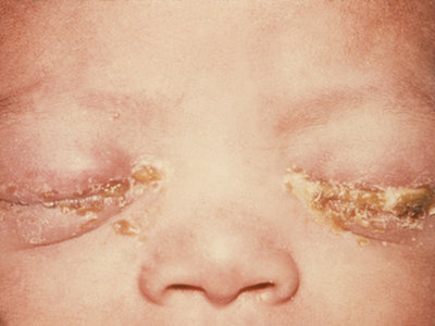 Rzeżączkowe zapalenie okolicy oczu u noworodka