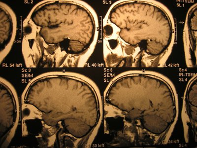 Wyniki badania tomografii głowy