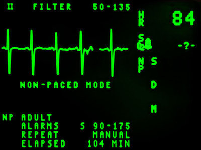 Ekran podczas badania EKG