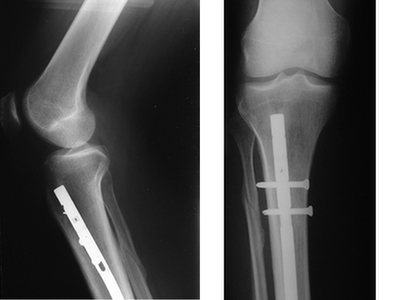 Zdjęcie rentgenowskie obrazujące złamanie kości